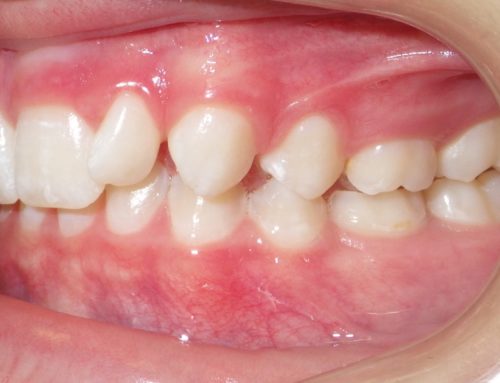 What Makes Teeth Shift?