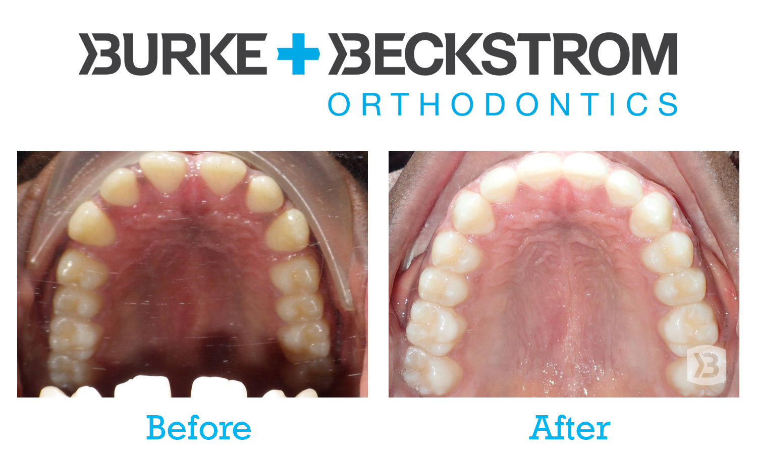 Burkebandatop Orthodontist St George Utah Burke Beckstrom Orthodontics 1357