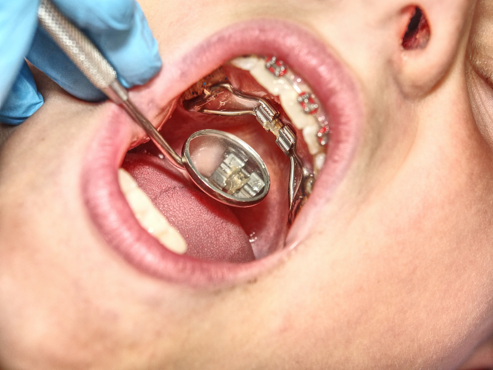 Picture of Teenager with Braces and Expander in Mouth
