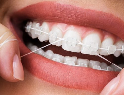 How to Floss with Braces?