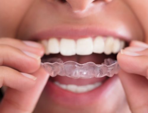 Tips for Cleaning Your Retainer