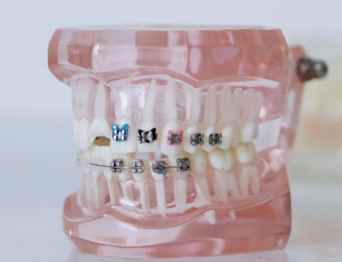 What Ages Are Appropriate for Braces?
