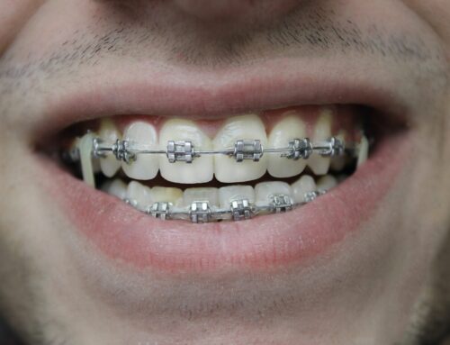 What Impact Do Braces Have on Facial Structure?