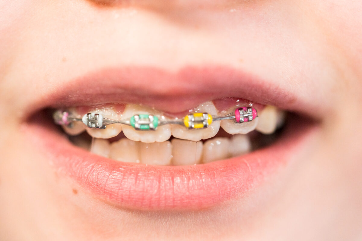 Orthodontic Care for Patients with Special Needs - Burke & Beckstrom ...